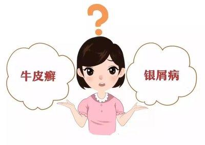 早期银屑病有哪些症状？